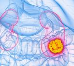 Kidney cancer, illustration
